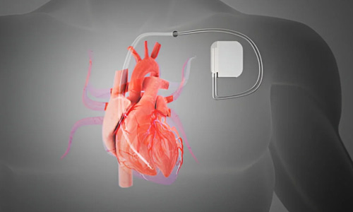 ICD Implantation in Nagpur